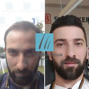 Trasplante de cabello antes y después - 24