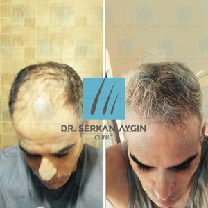Trasplante de cabello antes y después - 26