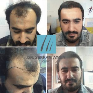 Trasplante de cabello antes y después - 5