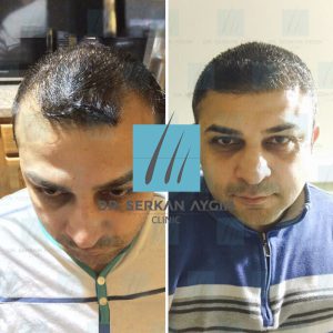 Trasplante de cabello antes y después - 8