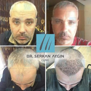 Trasplante de cabello antes y después - 13