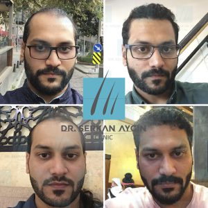 Trasplante de cabello antes y después - 19