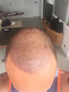 Trasplante de cabello antes y después - 62