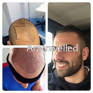 Trasplante de cabello antes y después - 50