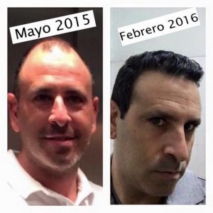 Trasplante de cabello antes y después - 49
