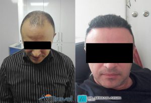 Trasplante de cabello antes y después - 47