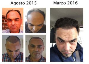 Trasplante de cabello antes y después - 46