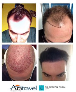 Trasplante de cabello antes y después - 45