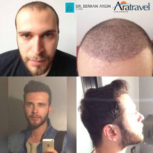 Trasplante de cabello antes y después - 44