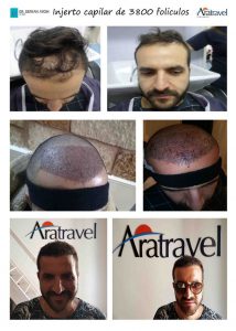 Trasplante de cabello antes y después - 43