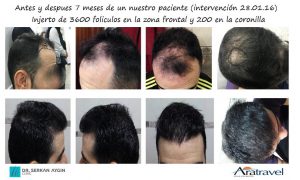 Trasplante de cabello antes y después - 42