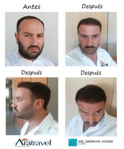 Trasplante de cabello antes y después - 40