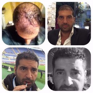 Trasplante de cabello antes y después - 55