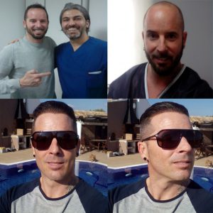 Trasplante de cabello antes y después - 52