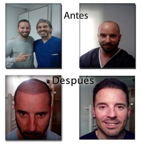 Trasplante de cabello antes y después - 51