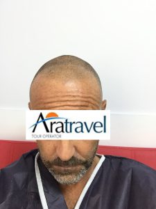 Trasplante de cabello antes y después - 59