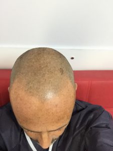 Trasplante de cabello antes y después - 60