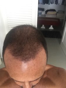 Trasplante de cabello antes y después - 65