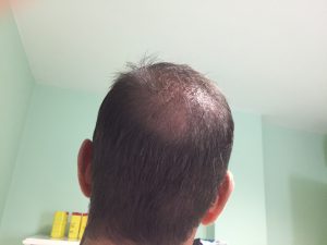 Trasplante de cabello antes y después - 69