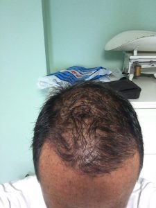 Trasplante de cabello antes y después - 68