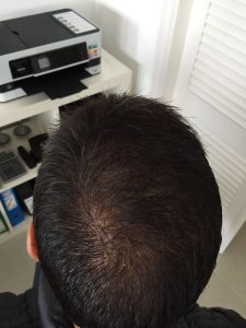 Trasplante de cabello antes y después - 71