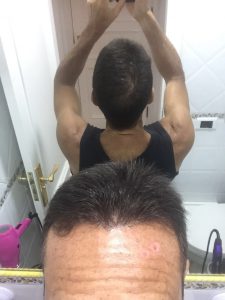 Trasplante de cabello antes y después - 73
