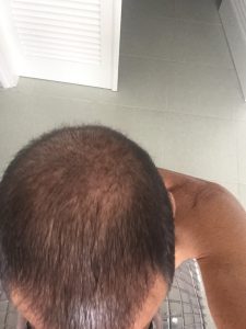 Trasplante de cabello antes y después - 66
