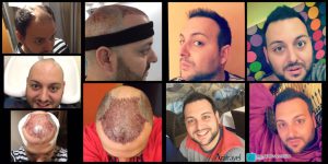 Trasplante de cabello antes y después - 32