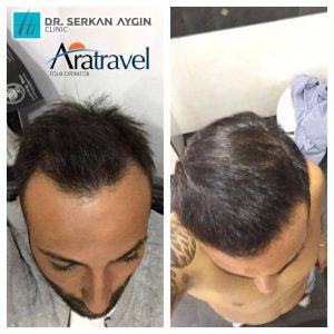 Trasplante de cabello antes y después - 56