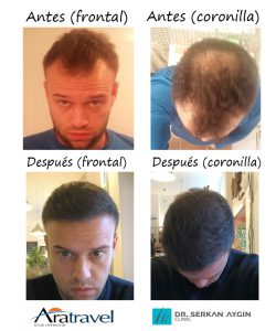 Trasplante de cabello antes y después - 58