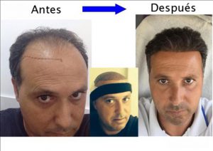Trasplante de cabello antes y después - 35