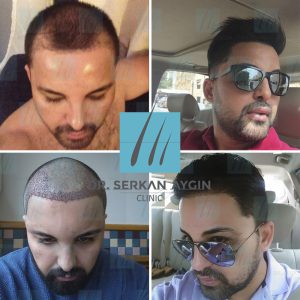 Trasplante de cabello antes y después - 20