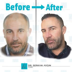 Trasplante de cabello antes y después - 36