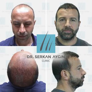 Trasplante de cabello antes y después - 1
