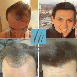 Trasplante de cabello antes y después - 31
