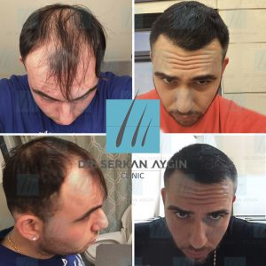 Trasplante de cabello antes y después - 30