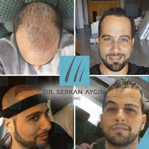 Trasplante de cabello antes y después - 6