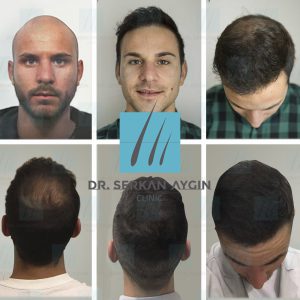 Trasplante de cabello antes y después - 17