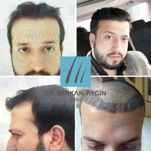 Trasplante de cabello antes y después - 11