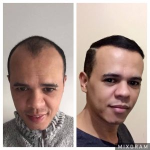 Trasplante de cabello antes y después - 37