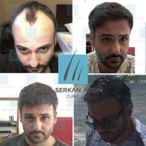 Trasplante de cabello antes y después - 15