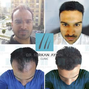 Trasplante de cabello antes y después - 29