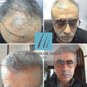 Trasplante de cabello antes y después - 23