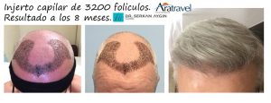 Trasplante de cabello antes y después - 39