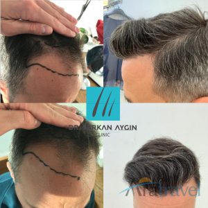 Trasplante de cabello antes y después - 2019_05