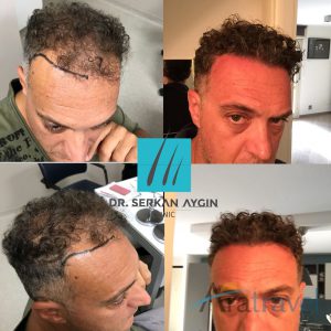 Trasplante de cabello antes y después - 2019_06