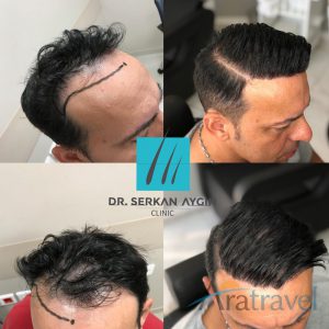 Trasplante de cabello antes y después - 2019_07