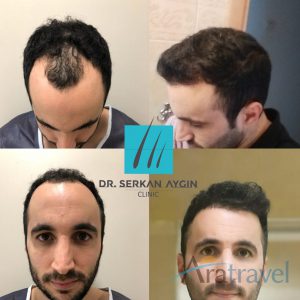 Trasplante de cabello antes y después - 2019_08