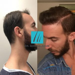 Trasplante de cabello antes y después - 2019_09