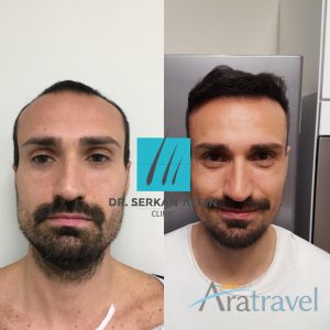 Trasplante de cabello antes y después - 2019_10
